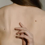 10 datos científicos sobre por qué los lunares pueden ser un signo de alerta para el cáncer de piel
