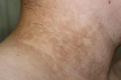 Acantosis Nigricans: 10 Datos Esenciales que Todos Deberían Conocer para Detectarla y Actuar a Tiempo