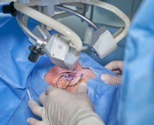 Cirugía del ojo con rayos láser: guía completa sobre procedimientos, beneficios y riesgos 3 Cirugía del ojo con rayos láser: guía completa sobre procedimientos, beneficios y riesgos