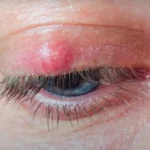 Guía completa sobre el Chalazión: causas, síntomas, tratamiento y prevención