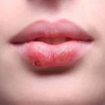 “Herpes: 10 remedios caseros efectivos para aliviar sus síntomas de forma natural”