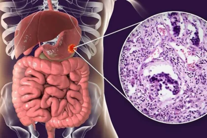 Cáncer gástrico: 10 síntomas iniciales que no debes ignorar para detectar a tiempo