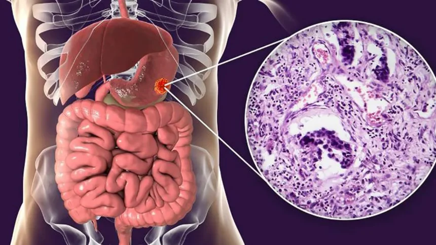Cáncer gástrico: 10 síntomas iniciales que no debes ignorar para detectar a tiempo
