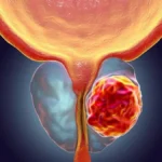 Cáncer de próstata: 10 datos clave sobre cómo se forma y por qué debes saberlo