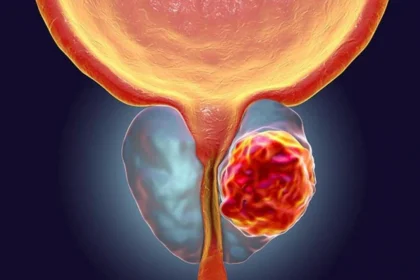 Cáncer de próstata: 10 datos clave sobre cómo se forma y por qué debes saberlo