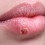 Top 10 Datos Científicos sobre la Transmisión del Herpes y Cómo Prevenir su Contagio Efectivamente