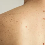 Top 10 Afecciones Cutáneas que Pueden Poner en Riesgo tu Vida: ¡No Subestimes tu Piel!